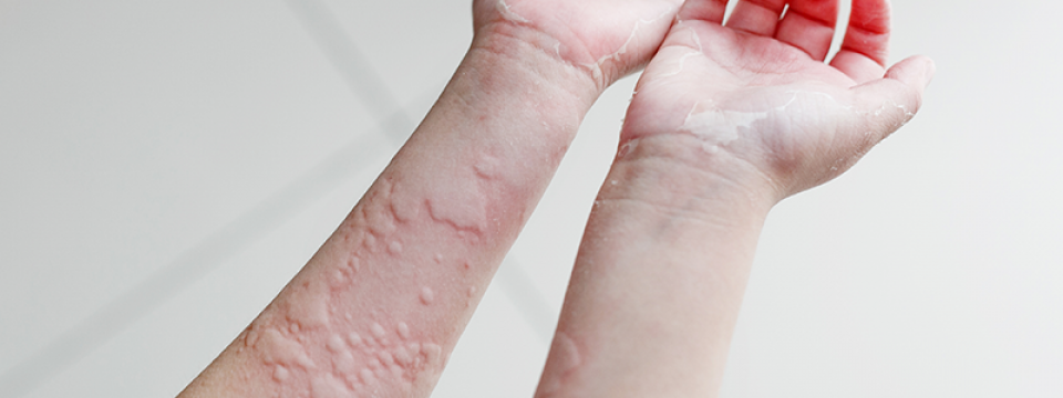 Urticaria