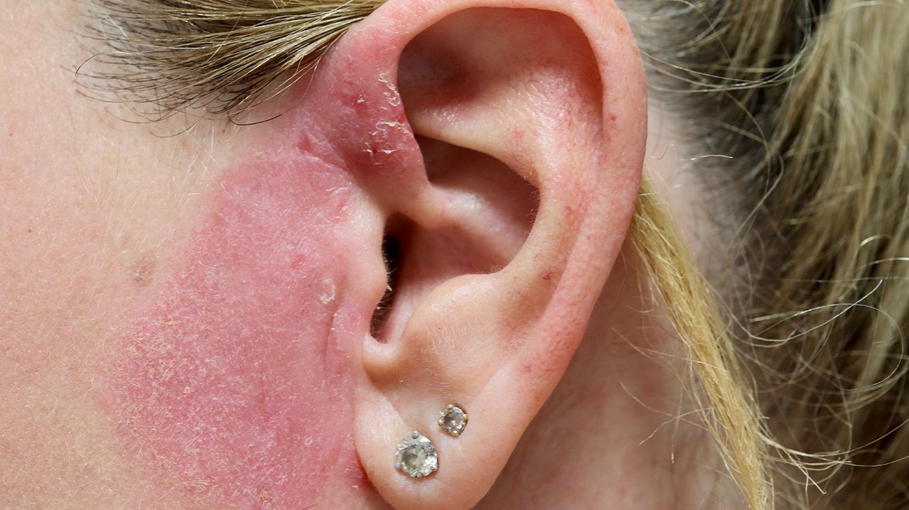 Allergiás kontakt dermatitis