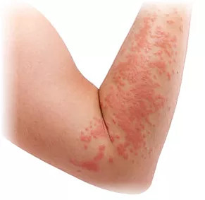Kontakt dermatitis